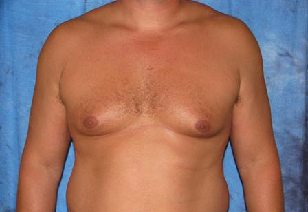 Male Breast Reduction Surgery Results Jacksonville