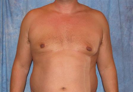 Male Breast Reduction Surgery Results Jacksonville