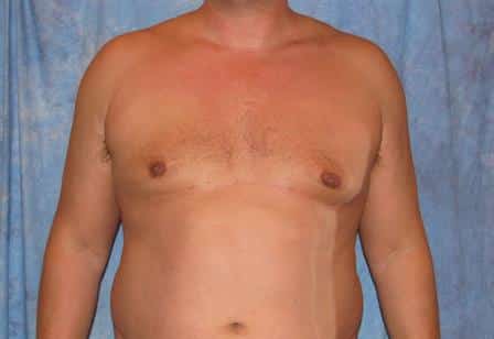 Male Breast Reduction Surgery Results Jacksonville