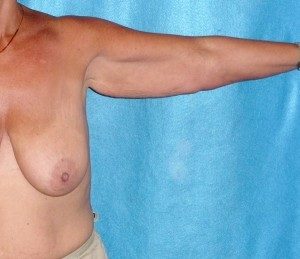 Woman before brachioplasty arm lift 