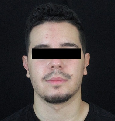 Otoplasty Jacksonville