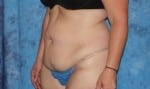 Abdominoplasty (Tummy Tuck)