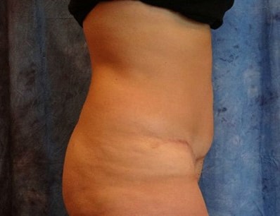 Abdominoplasty (Tummy Tuck)