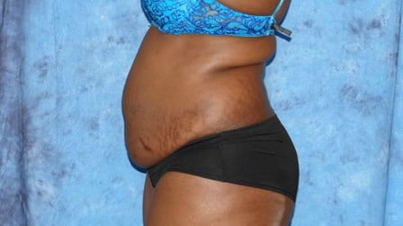 Abdominoplasty (Tummy Tuck)