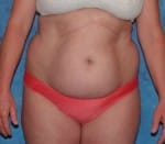 Abdominoplasty (Tummy Tuck)