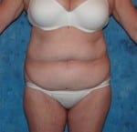 Abdominoplasty (Tummy Tuck)
