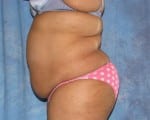 Abdominoplasty (Tummy Tuck)