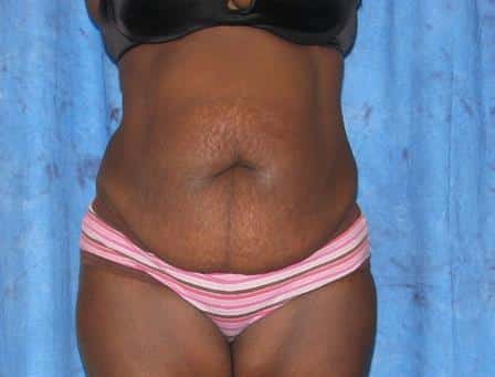 Abdominoplasty (Tummy Tuck)