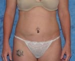 Liposelection