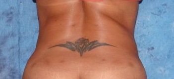 Liposelection