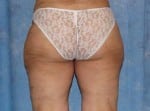 Liposelection