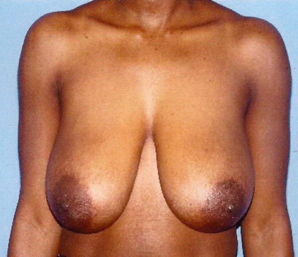 Breast Reduction-Female