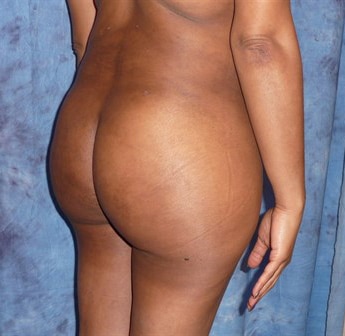 Brazilian Butt Lift