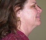 Facelift