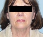 Facelift