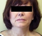 Facelift