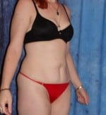 Mini-abdominoplasty (Mini- Tummy Tuck)