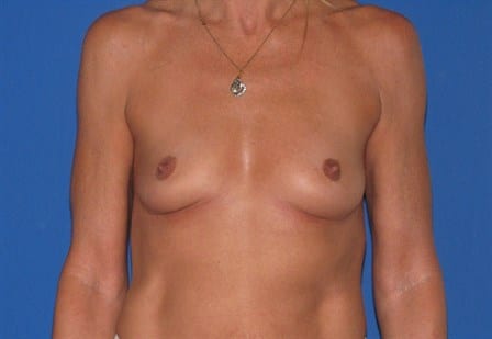 Breast Augmentation