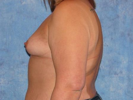 Breast Augmentation