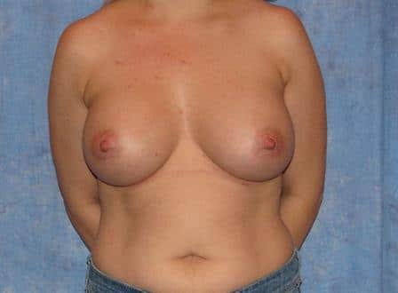Breast Augmentation