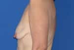 Breast Lift with Implant