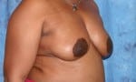 Breast Reduction-Female