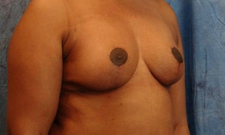 Breast Reduction-Female