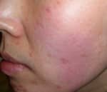 Fractional Skin Rejuvenation – Pixel