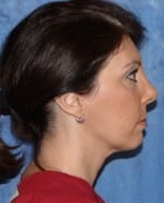 Laser Facelift with PrecisionTx