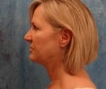 Laser Facelift with PrecisionTx