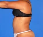 Abdominoplasty (Tummy Tuck)