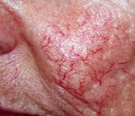 Vascular Lesions