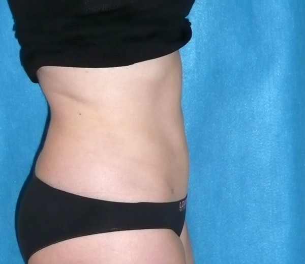 Liposelection