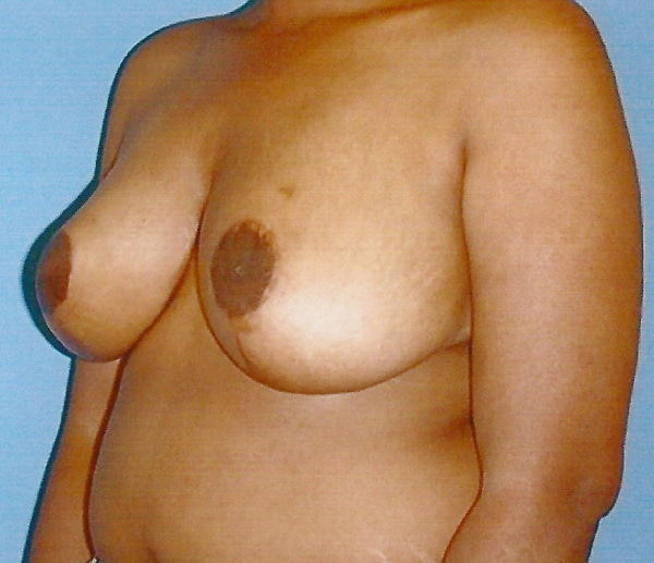 Breast Reduction-Female
