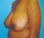Breast Reduction-Female