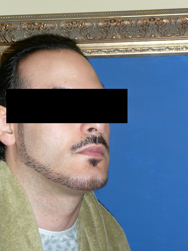 Male Chin Implant