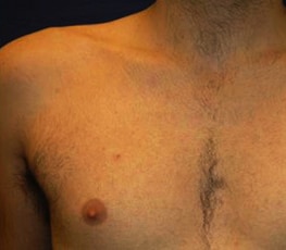 Male Laser Hair Removal