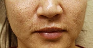 Microneedling