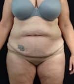 Abdominoplasty (Tummy Tuck)