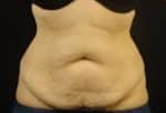 Abdominoplasty (Tummy Tuck)