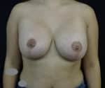 Breast Lift with Implant