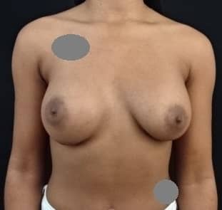 Breast Augmentation