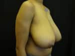 Breast Reduction-Female