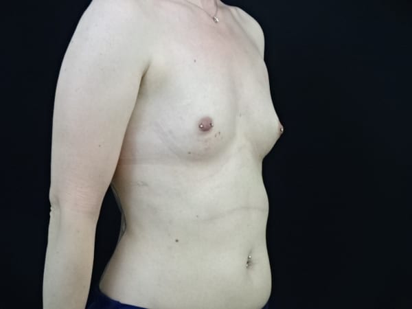 Breast Augmentation