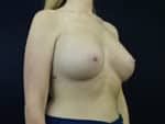 Breast Augmentation