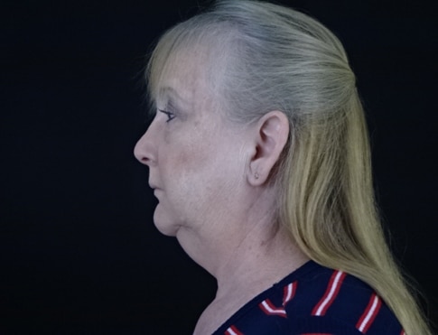 Facelift