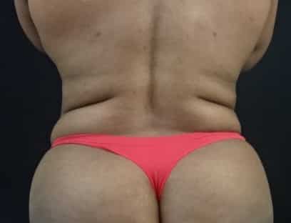 Liposelection