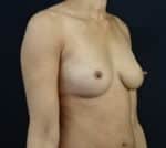 Fat Transfer Breast Augmentation