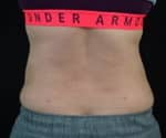 Liposelection